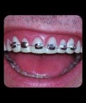 Sztuczne zęby - Brzydula