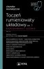 Toczeń rumieniowaty układowy Część 1 Rozpoznawanie i leczenie 