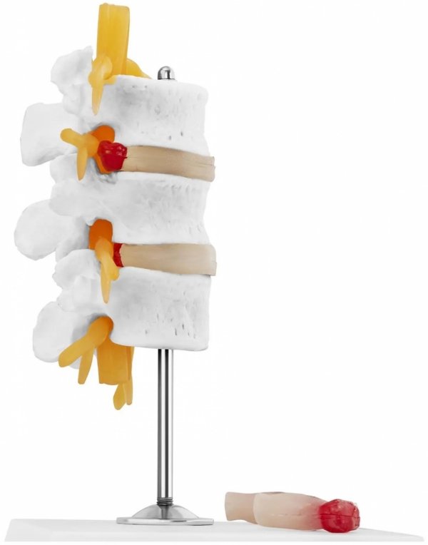 Odcinek lędźwiowy z przepukliną kręgosłupa - model anatomiczny Physa  PHY-SM-6 10040324 4062859971579